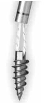 Smith And Nephew Twinfix Ti 2.8 Suture
