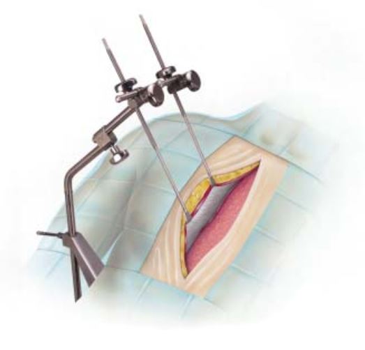 OMNI-TRACT PITTMAN IMA RETRACTOR SYSTEM CS200